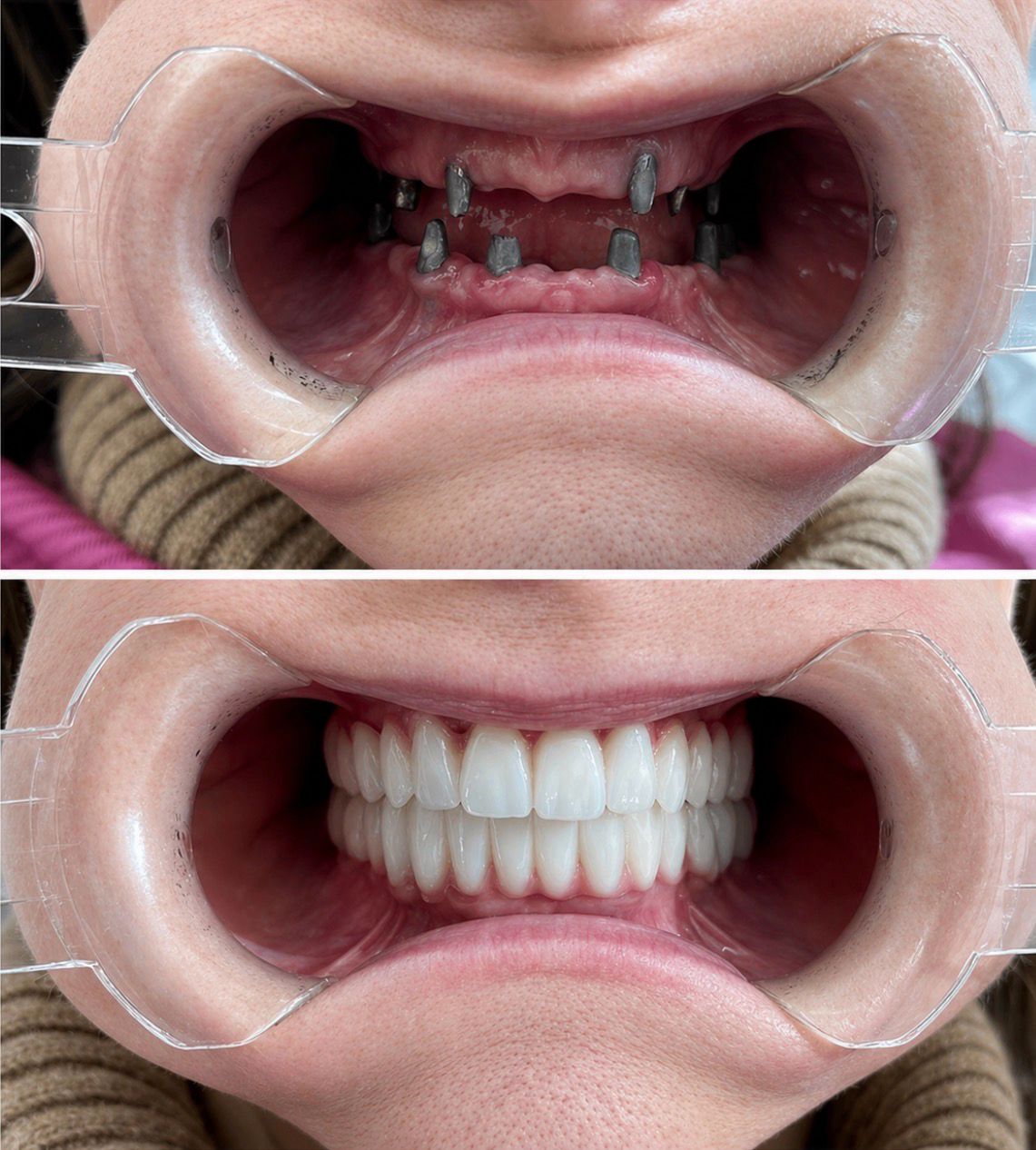 Implantologia Dentale